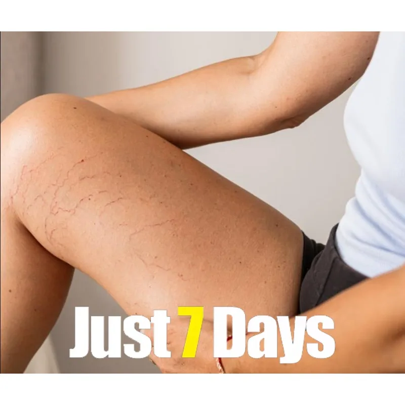 Ointment for Varicose Veins Eliminate Vasculitis Phlebitis to Relieve Spider Leg Pain Treatment Herbal cream
