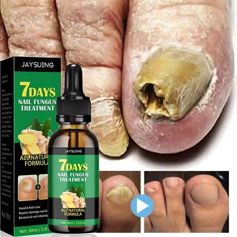 Nail Fungal Treatment Serum Foot Toe Nail Fungus Removal Anti Infection Onychomycosis Paronychia Repair Care Essential Oil