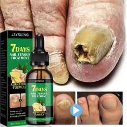 Nail Fungal Treatment Serum Foot Toe Nail Fungus Removal Anti Infection Onychomycosis Paronychia Repair Care Essential Oil