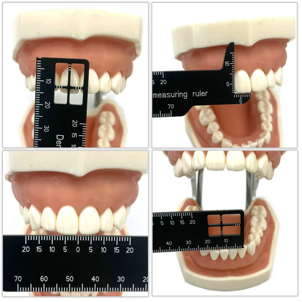 Dental Ruler 1pc Dental Precision Measuring Ruler For Implant And Orthodontics Dentistry Measuring Instrument