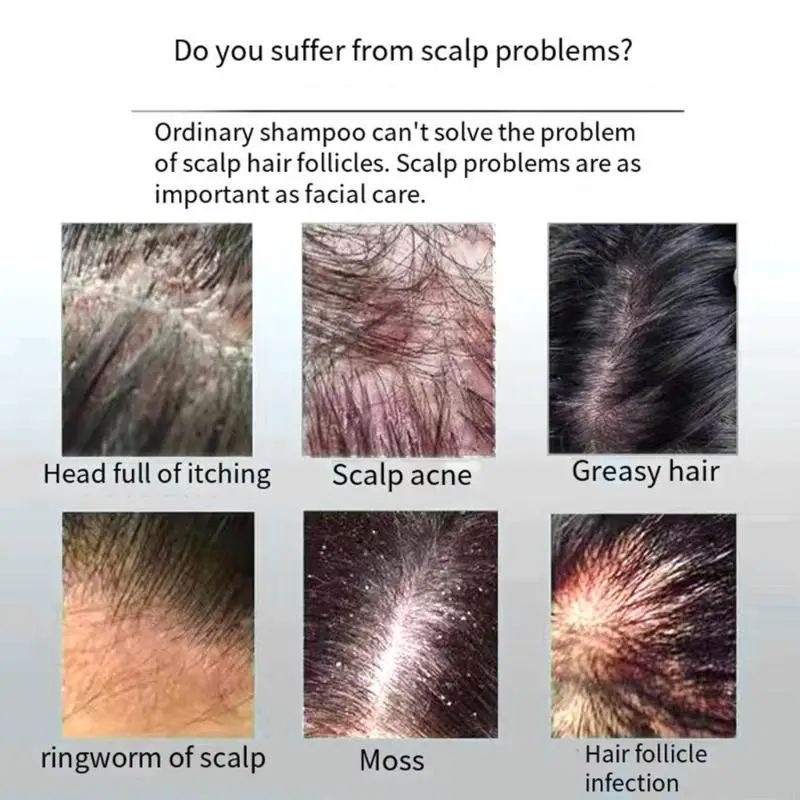 U0DE 110 مل شامبو لوشن قطران الفحم المضاد للبكتيريا السائل للقشرة والحكة للعناية بالشعر