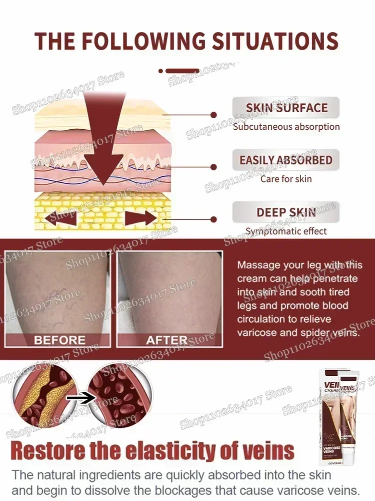 ใหม่ Original Vasculitis การไหลเวียนโลหิตเส้นเลือดขอด Treatment ครีมใหม่ 20g