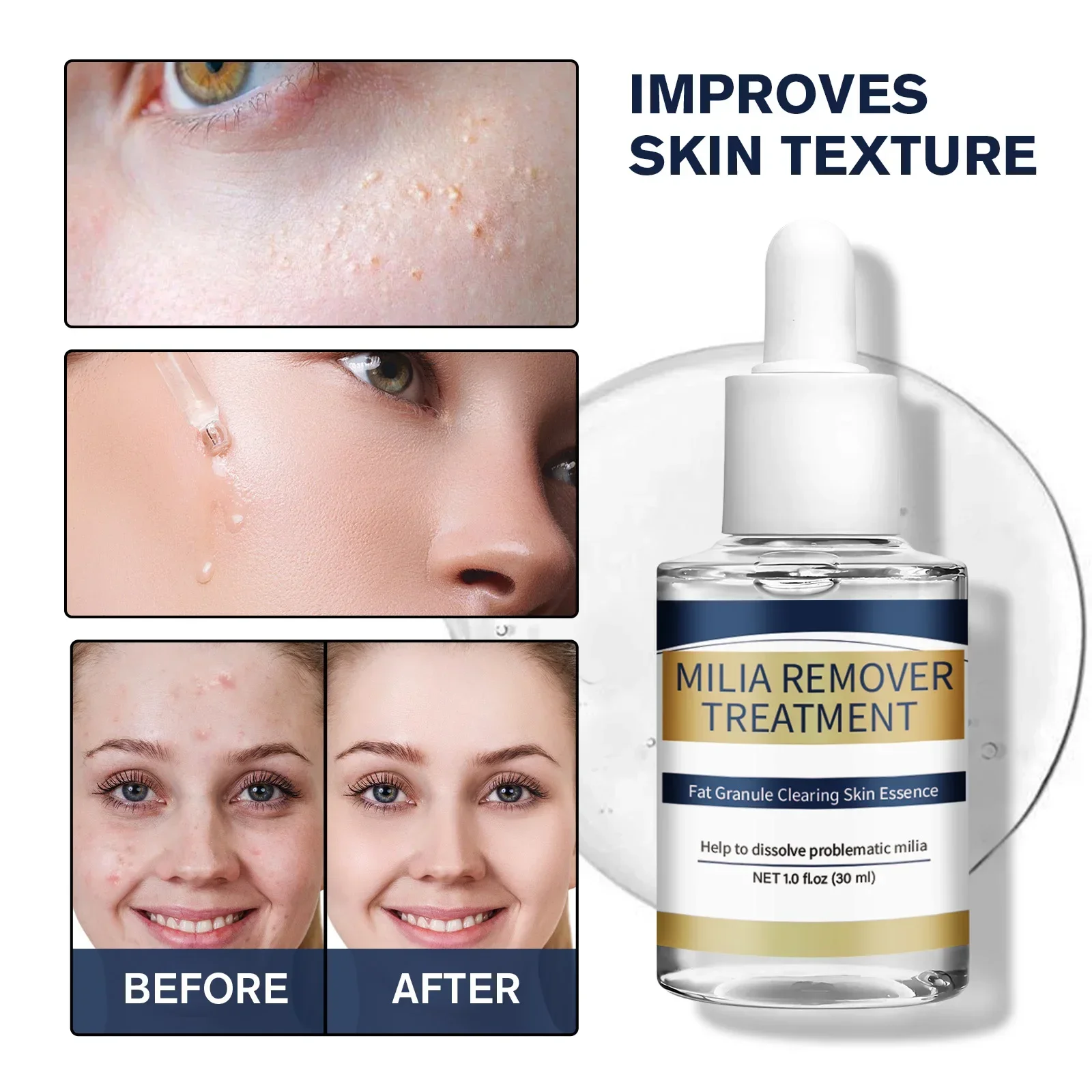 

Milia Remover Essence Treatment Fat Granule Clearing Skin Hyaluronic Acid Deep Hydration and Gentle Exfoliation Hydrates Smooths