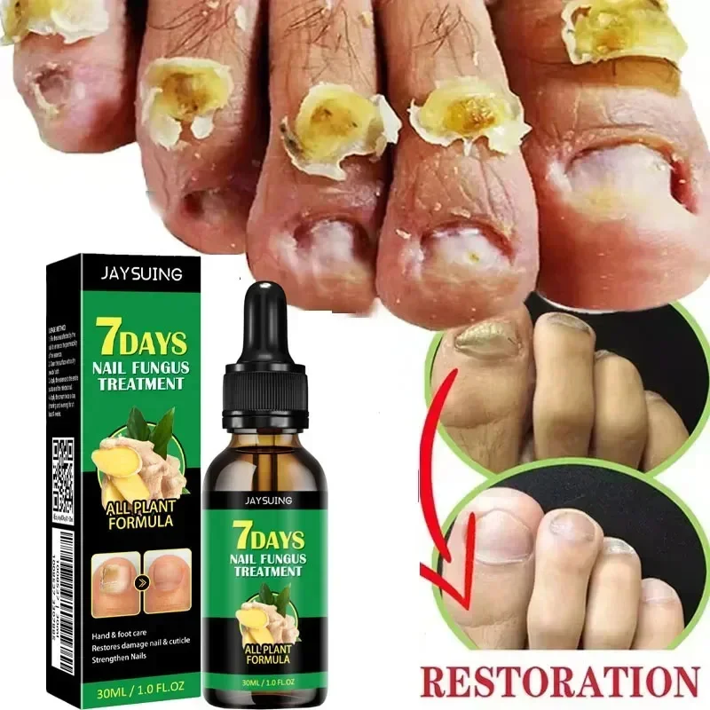 Nail Repairing Liquid Essence Hand Care Foot Fungal Removal Repair Serum Anti-infective Paronychia Nail Polish Repair Products