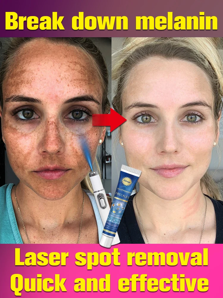 Freckles Melasma Removal Dark Spots Remover For Face