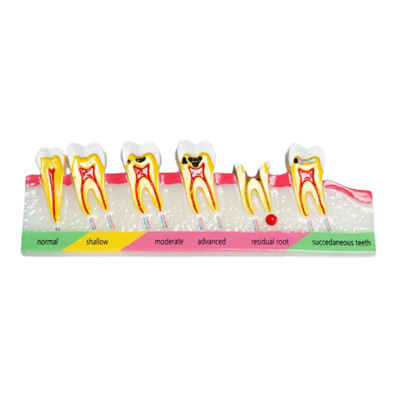 

Teeth Model Dental Implant Dental Demonstration for Teachers Kids School