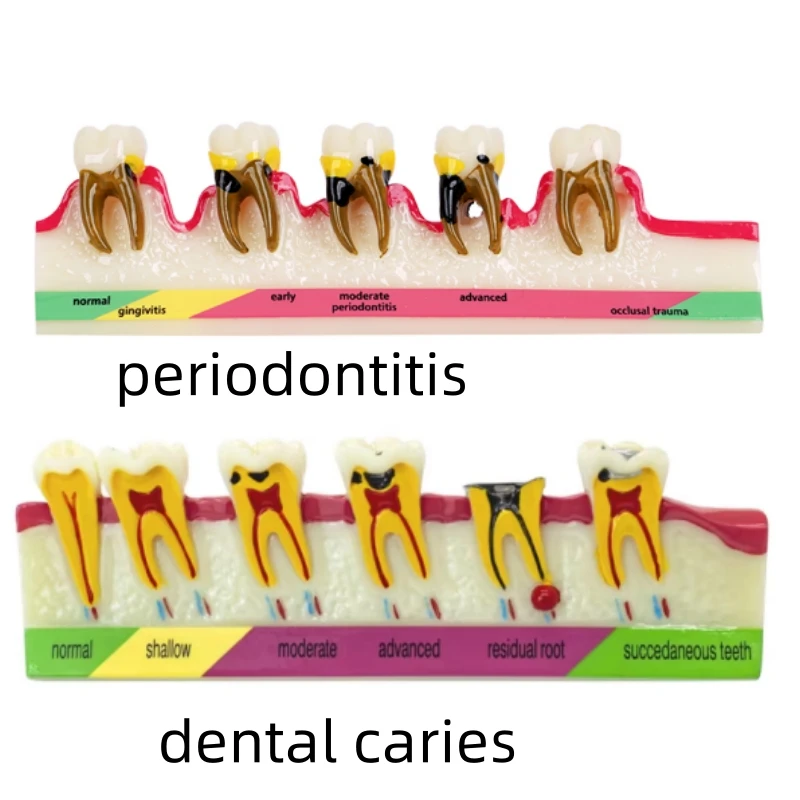 Dental Teaching Model Tooth Development Evolution Models Periodontal Disease Caries Demo Communication