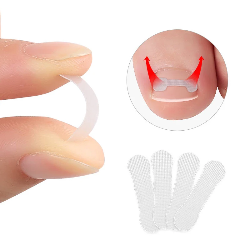 10Pcs Ingrown Toenail Corrector Tools Pedicure Recover Embed Toe Nail Professional Ingrown Toenail Straightening Clip Brace