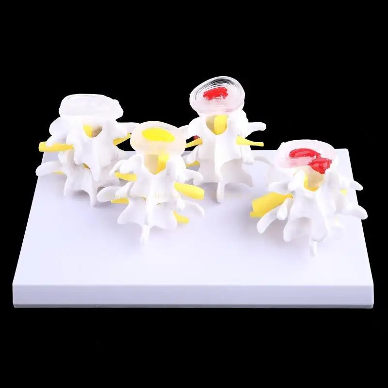 1 Set Human Lumbar Lesion Spine Statue Display Model Medical Teaching Learning f