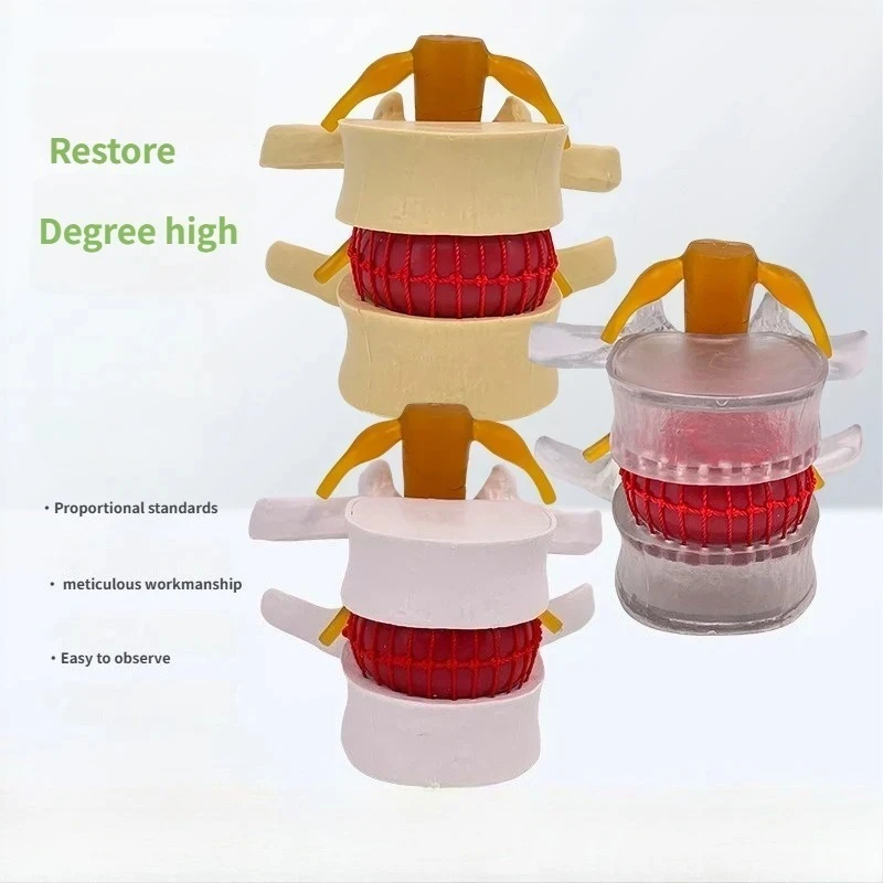 1.5X Human Anatomical Lumbar Disc Herniation Model, Movable Human Lumbar Disc Herniation Model Teach Demonstrating Tool