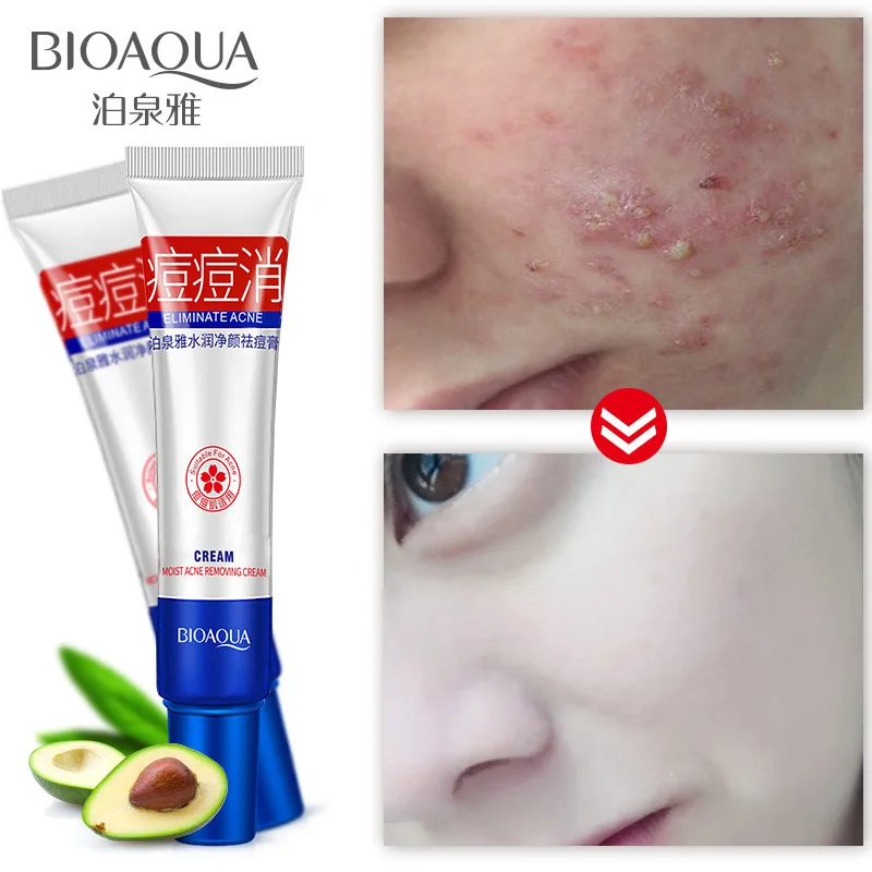 Крем BIOAQUA для удаления акне, лечение акне, крем для удаления черных точек, уход за кожей, сужение пор, защита кожи лица