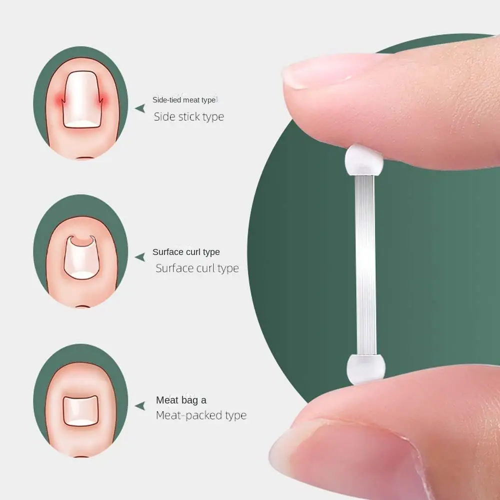 Ingrown Toenail Recover Toe Braces Pedicure Tool Bunion Corrector Ingrown Toenails Corrector Toenail Straightener Toenail Fixer