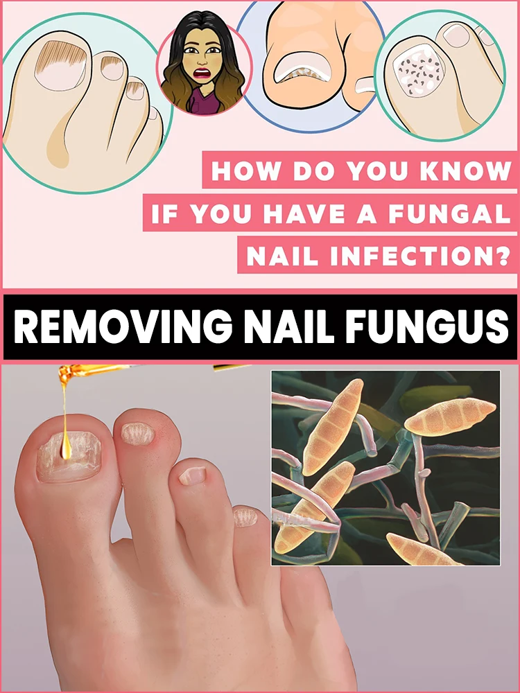 Tea Tree Nail Treatment Fights fungal nails and is a general daily care solution for both men and women.