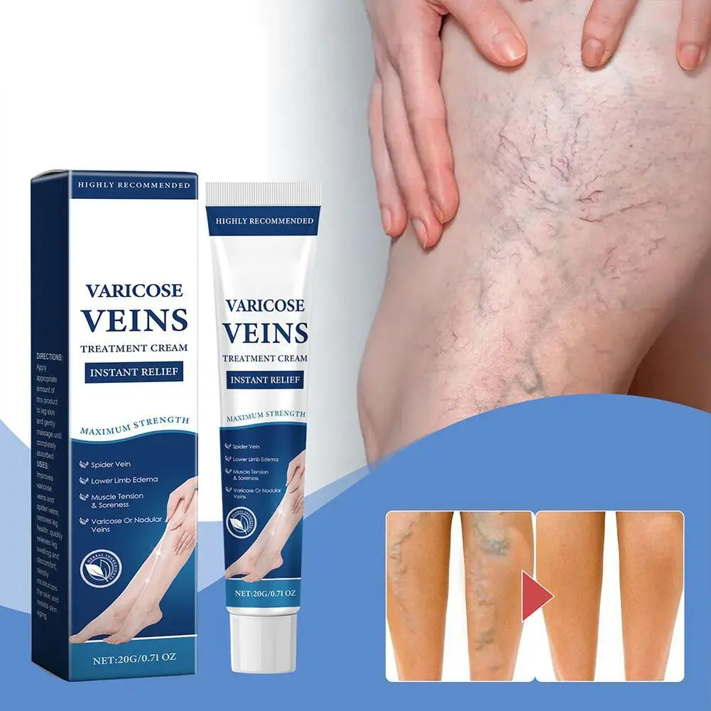 Spider Blood Varicose Veins Effective Varicose Vein Relief Cream To Relieve Vasculitis Phlebitis Spider Pain Treatment N EWW