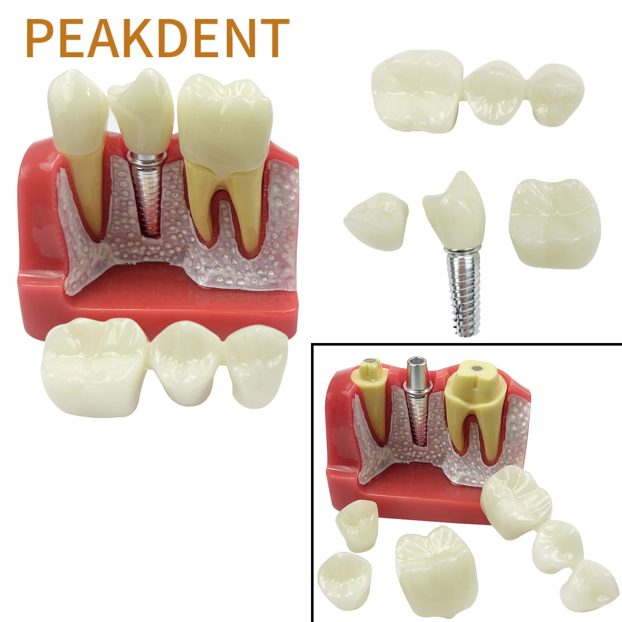 Dental 4 Times Implant Teeth model Analysis Crown Bridge Demonstration Removable Model Dentist Patient Demonstration Model