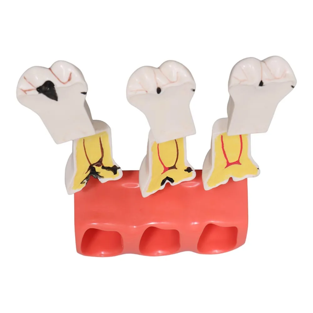 Dental Model Dental Caries Development Caries Disintegration Model 3 Stage Quadruple Multiplication