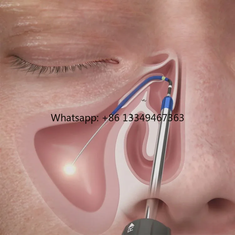 Adult Sinus Surgical Sinus Balloon Dilation Catheter for Restore Sinus Ventilation and Drainage