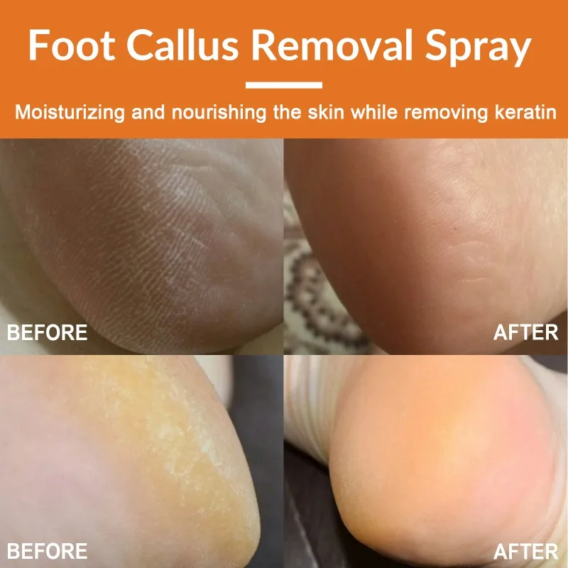 Foot Callus Removal Spray Orange Essential Oil Exfoliating Nourish Peel Feet Calluses Dead Skin Remover Pedicure Foot Care Tool