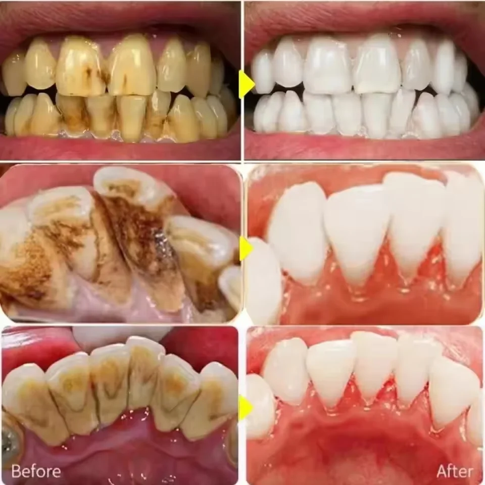 Dental Calculus Remover Teeth Whitening Serum Brightening Cleaning Oral Hygiene Removal Halitosis Plaque Stains Fresh BreathCare