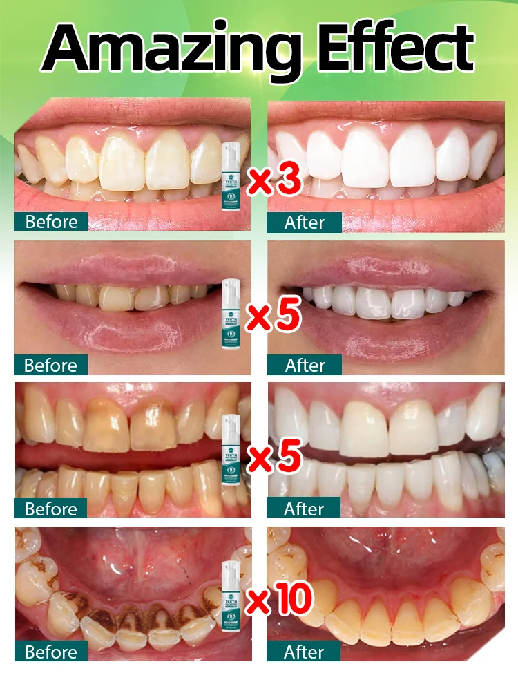 Teeth whitening Tooth Brighten TartarRemoval