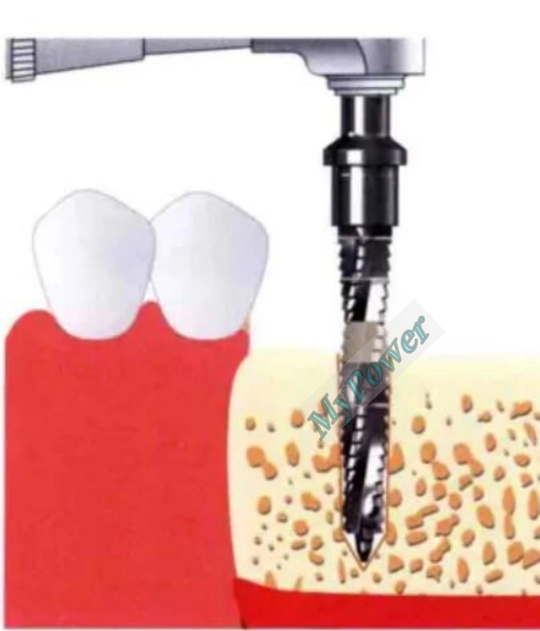 ∅M1.8 Dental Cross Cutter Drill Implant Bone Side Cut Debris Blade Fit Lindemann Oss flat head