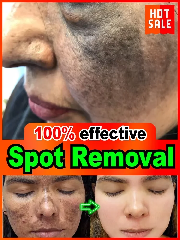 

100% safe and effective, Pʀᴏғᴇssɪᴏɴᴀʟʟʏ ᴄʀᴀғᴛᴇᴅ sᴘᴏᴛ ʀᴇᴍᴏᴠᴀʟ ᴇssᴇɴᴄᴇ