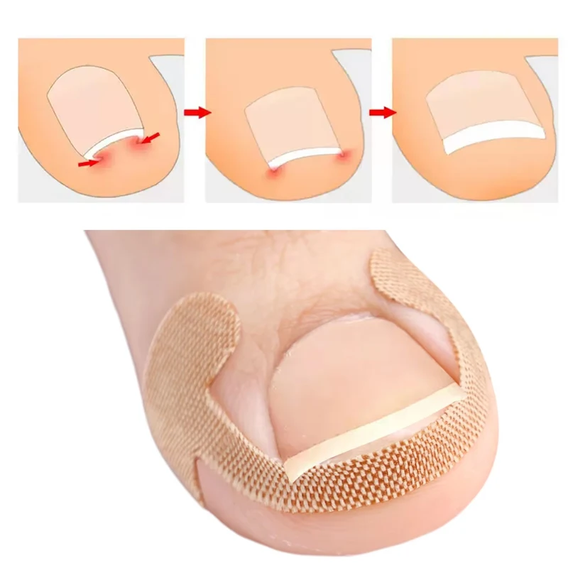 20-100pcs Adhesive Toenail Patch Ingrown Toe Nail Correction Sticker Foot Corrector Pedicure Health Care Tools Toe Treatment Pad - view 3