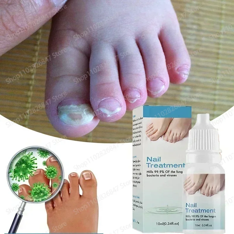 Anti-Infection Cream Fungus Nail Removal Fungus Foot Repair Serum