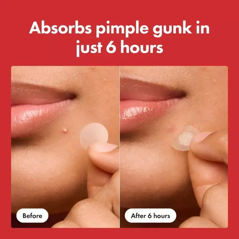 Thumbnail 2 - #4 Top 10 Acne Treatments & Kits Worth Buying In 2026