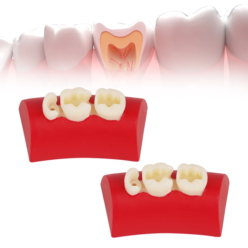 

Dental Inlay Exercise Model Block Composite Resin Filling Practice Model Oral Filling Typodont Model for Teaching Studying
