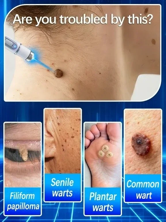 Gentle and non-irritating, quickly removes and repairs warts, fast results – a miracle cure for wart problems.