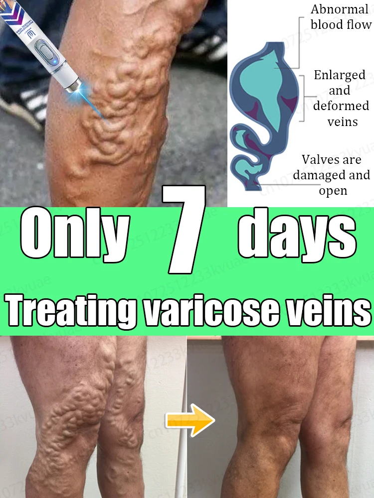 

Say goodbye to varicose veins, laser eradication of varicose veins, safe and no recurrence