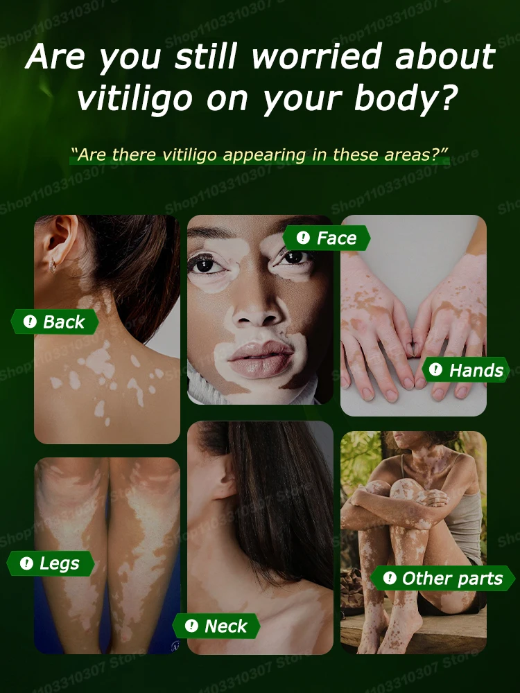 Vitiligo-Anti-Ringworm-Salbe, entfernt weiße Flecken