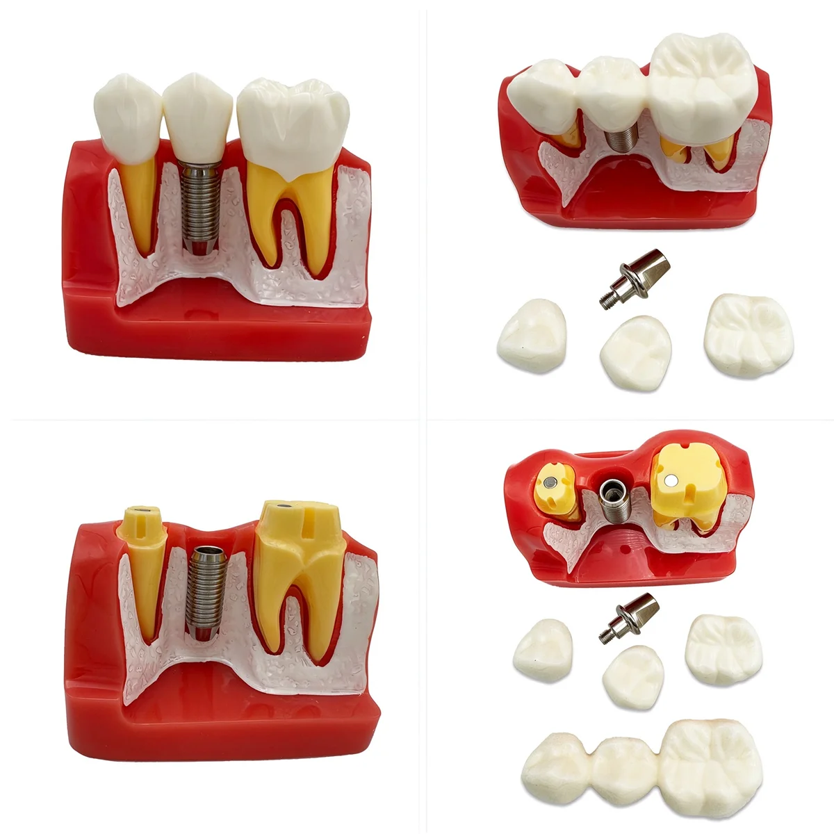 Tooth Model Dental 4 Times Implant Teeth Model Removable Analysis Crown Dentistry Demonstration Models Implants Study Training