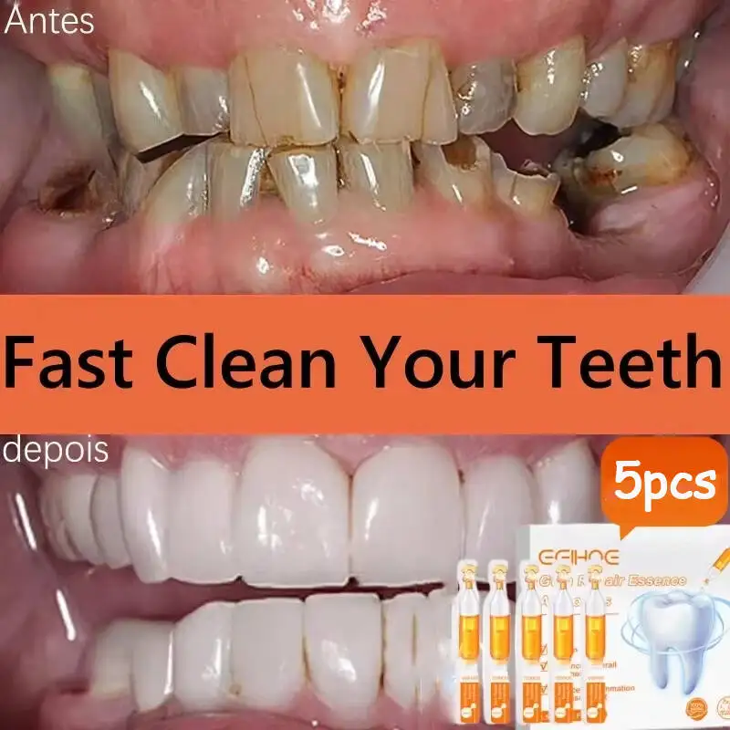 Schnell reparierendes Zahnfleischserum, lindert Nachwachsen von Zahnfleisch, Tropfen, Zahnaufhellung, Entfernung von gelben Plaque-Flecken, Karies, Zahnschmerzen, Zahnpasta