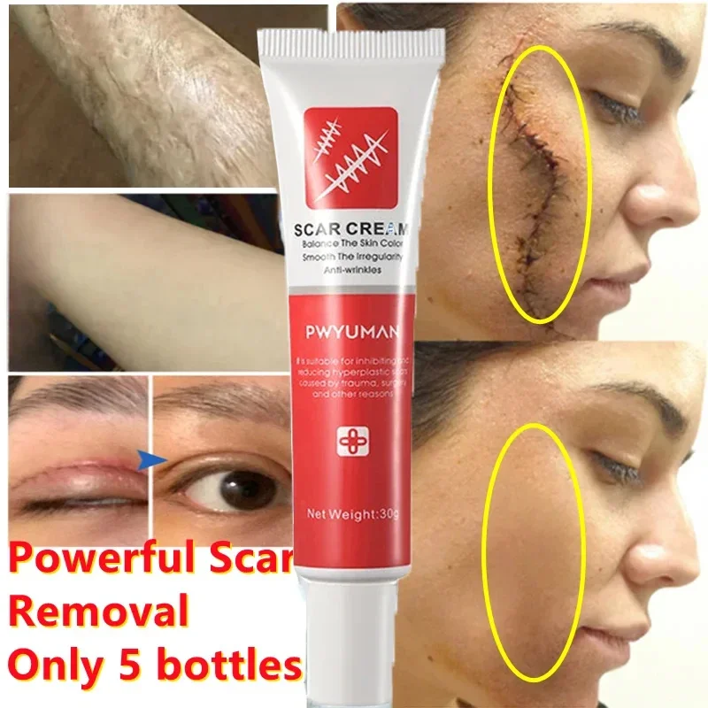 Fast Scar Removal Cream Effective Treatment Stretch Marks Burn Surgical Scars Acne Spots Repair Whitening Moisturizing Skin Care