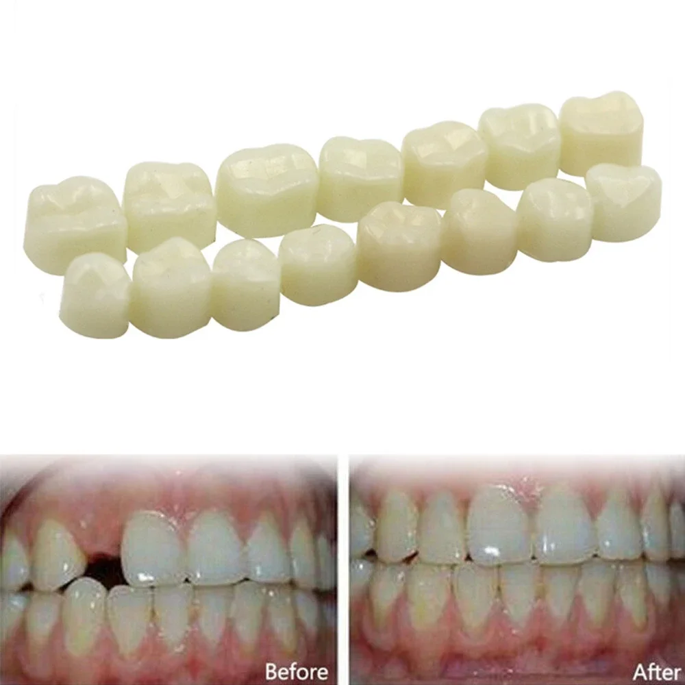 Dental Teeth Veneers Ultra Thin Whitening Resin Anterior Upper Temporary Crown Porcelain Dental Material For Oral Care