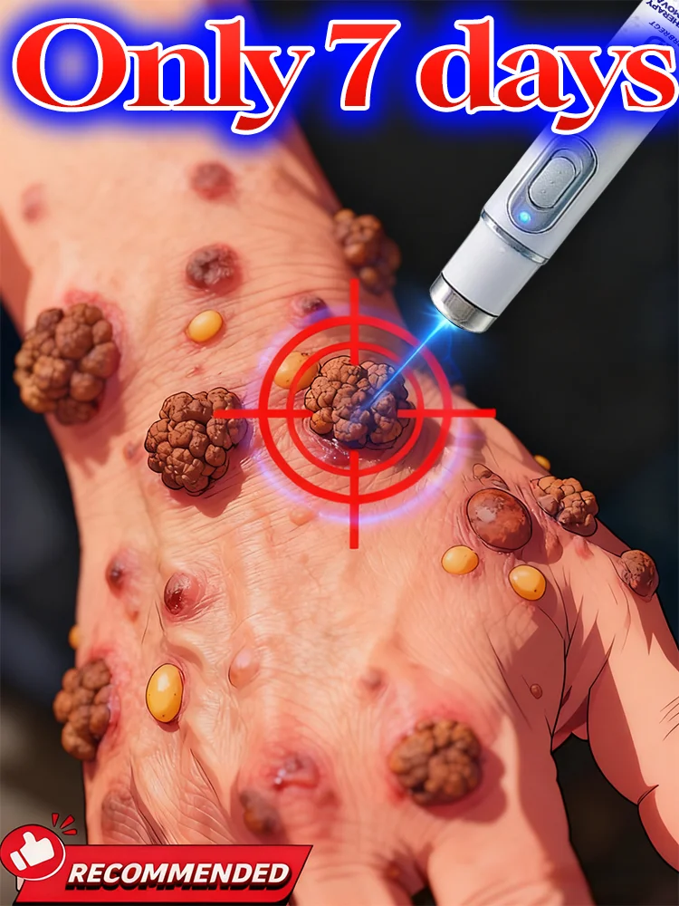 

ᴸᵃˢᵉʳ ᵖᵉⁿ ᵃᶜᶜᵘʳᵃᵗᵉˡʸ ʳᵉᵐᵒᵛᵉˢ warts without scarring or recurrence