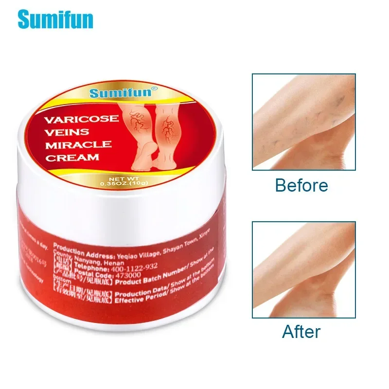 

Sdotter New Varicose Veins Relief Cream Leg cramps Vasculitis Phlebitis Spider Shape Vein bulges Pain Ointment Angiitis Removal