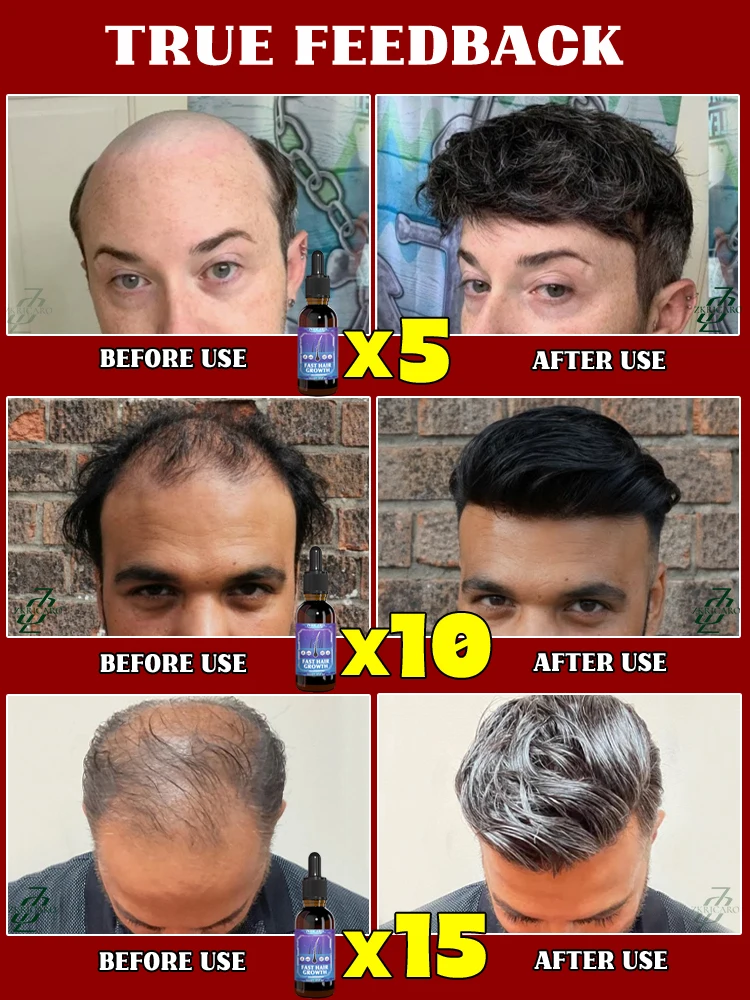 30ml de óleo para cuidados capilares ZKRICARO para nutrir as raízes do cabelo Mais e mais pelos.