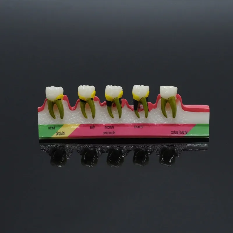 

Periodontal Disease Five-stage Demonstration Dental Mold Dental Caries Teaching and Research Three-dimensional Enlarged Design