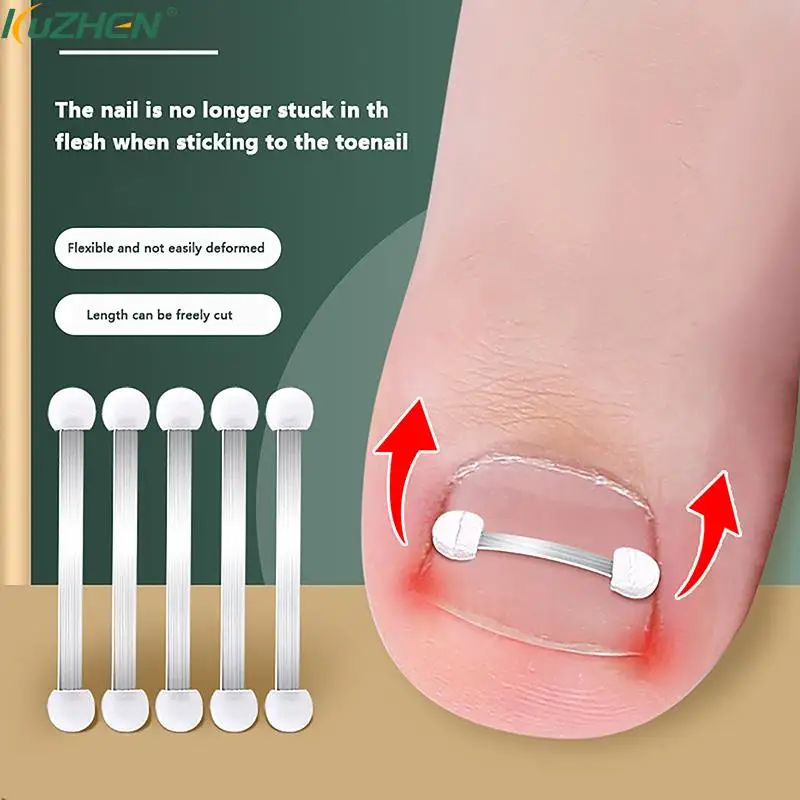 Ingrown Toenail Cor…