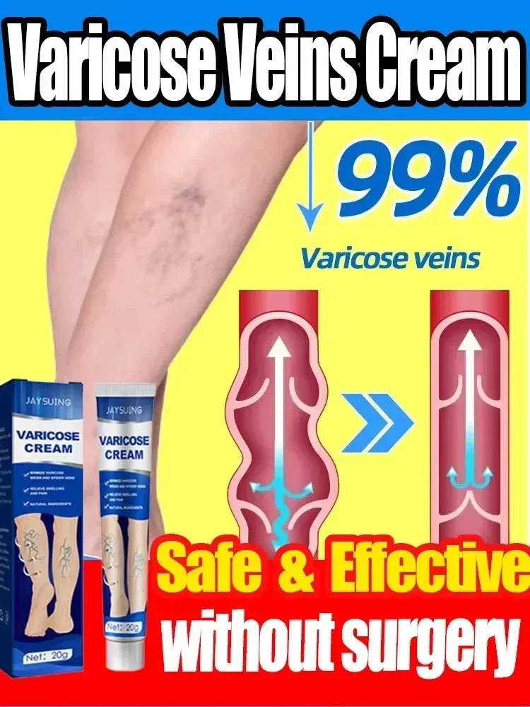 Pomada para venas varicosas, crema efectiva para aliviar la Vasculitis, flebitis, tratamiento del dolor de araña, cuidado de los pies