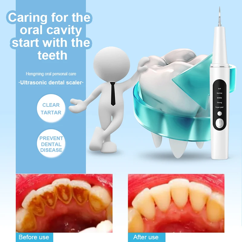 لاسلكي الترا سونيك مبيضة أسنان للأسنان الجير وصمة عار التفاضل والتكامل مزيل الكهربائية سونيك الأسنان البلاك الأنظف إزالة الحجر