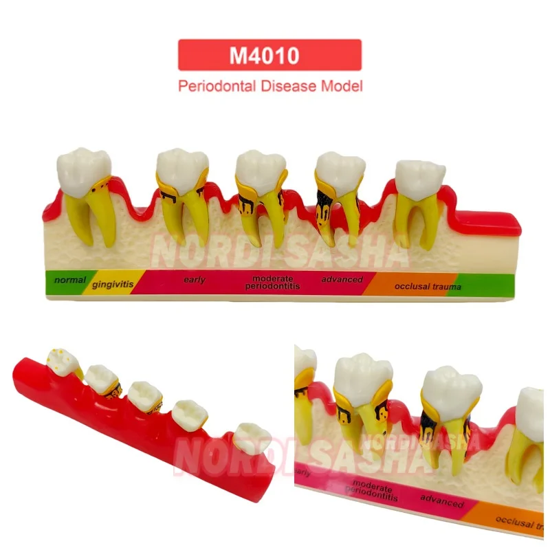 1Pcs M4010 Periodontal Disease Model Dental Typodont Periodontal Disease Progression Teaching Model Demonstration Model