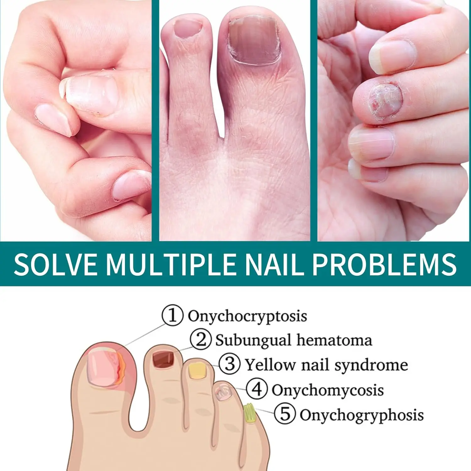 爪真菌治療パッチ、夜間8時間再生、損傷した爪、変色した真菌感染症、爪修復パッチ