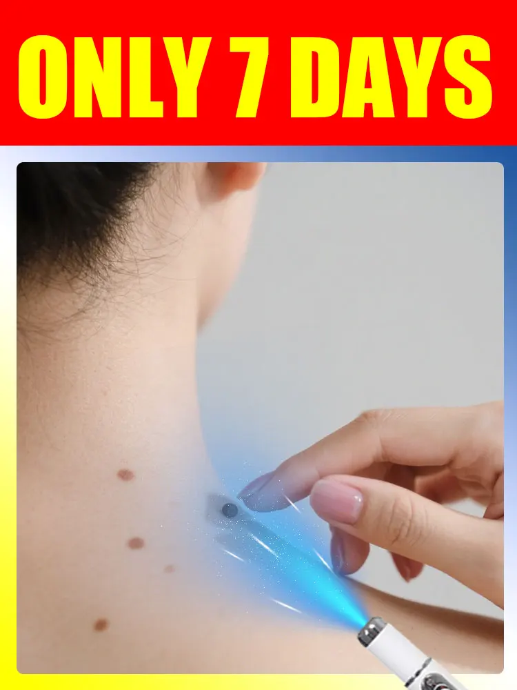 Stylo à lumière bleue pour résoudre les verrues corporelles, outils de soins des verrues