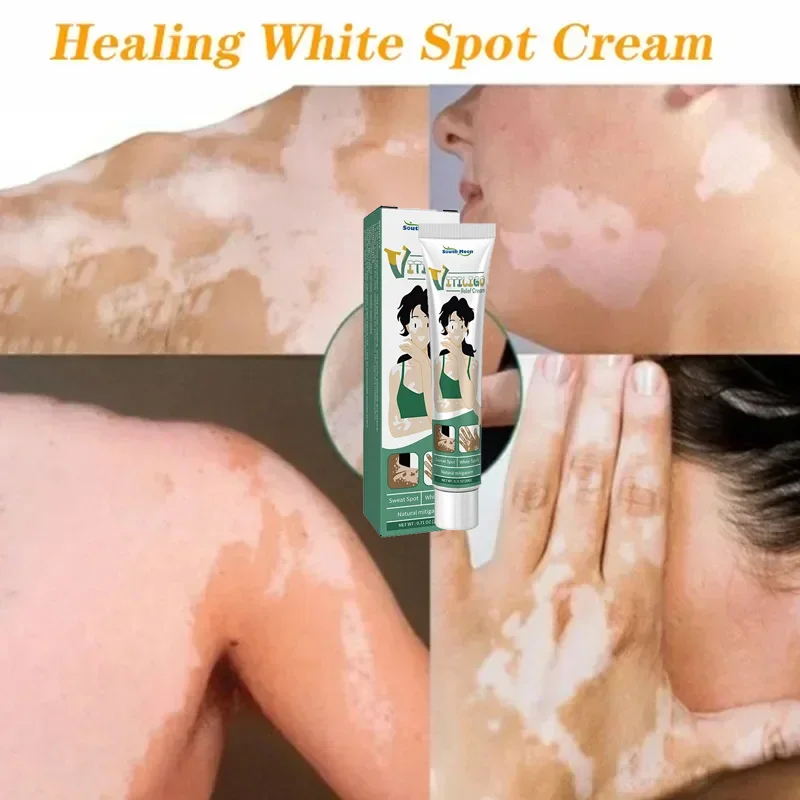 

Vitiligo Ointment White Spot Disease Treatment Melanin Promoting Liniment Chinese Herbal Leukoplakia Treatment Cream