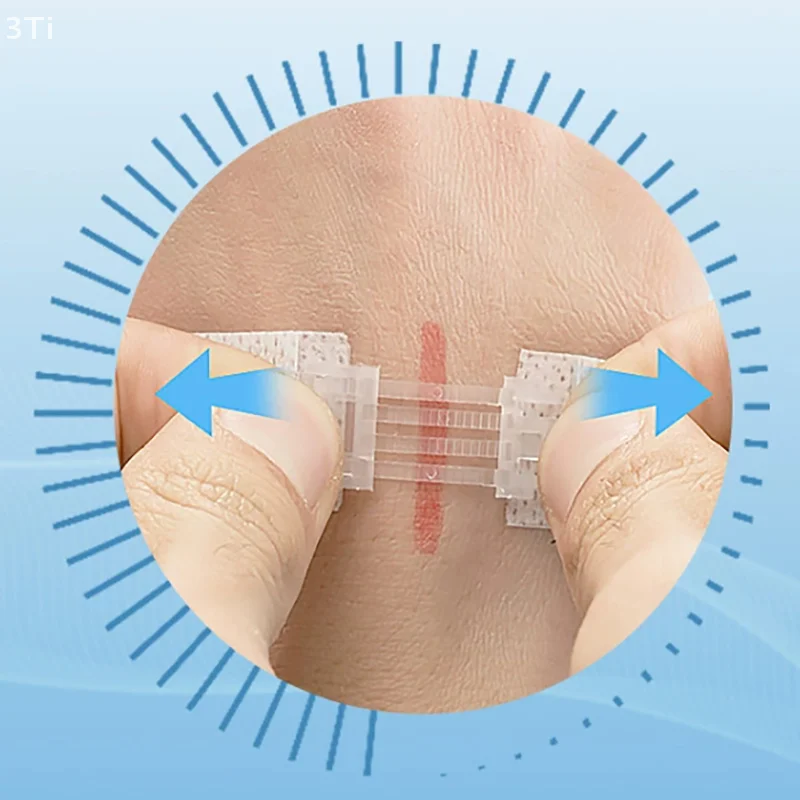 1 قطعة سستة التعادل الجرح إغلاق التصحيح المحمولة خياطة سريعة مرقئ التصحيح ضمادة مرنة في الهواء الطلق الإسعافات الأولية أداة العناية بالبشرة