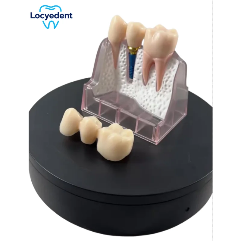 Dental Demonstration Model 4 Times Teach Implant Analysis Crown Bridge Detachable Model Dentistry Teaching Study Training Models